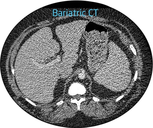 Bariatric CT