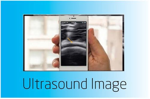 Ultrasound iphone photo